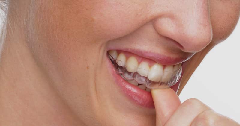 Qu’est-ce que le traitement orthodontique Invisalign ?